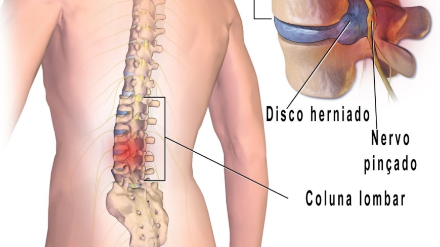 O que é a hérnia de disco?